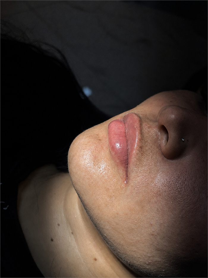 Harmonização orofacial, caso 3, depois