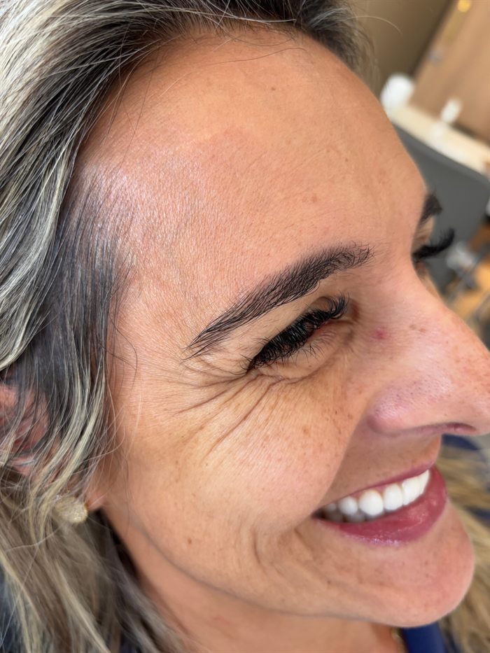 Caso 6 — região dos olhos da paciente antes do tratamento.