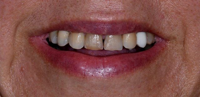Odontologia estética, caso 1, antes
