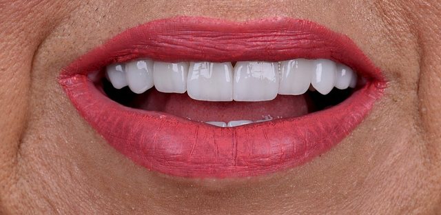 Odontologia estética, caso 1, depois