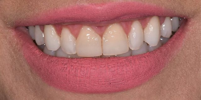 Odontologia estética, caso 2, antes