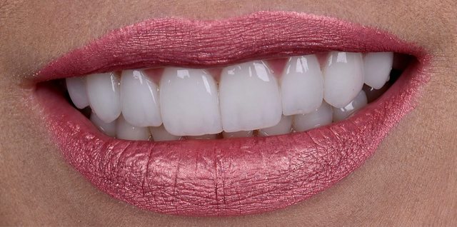 Odontologia estética, caso 2, depois