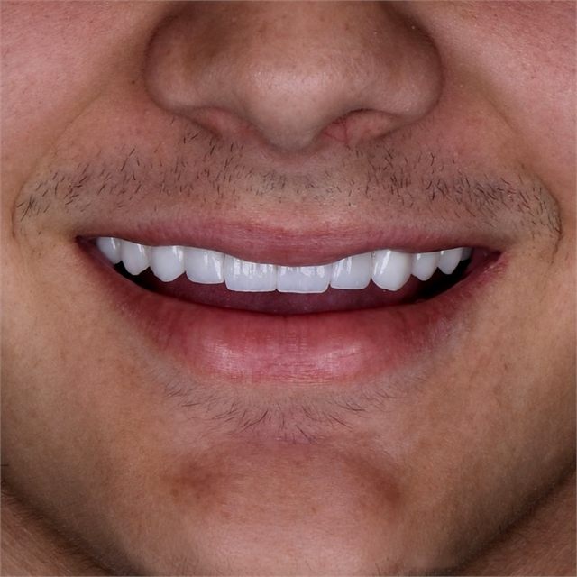 Odontologia estética, caso 4, registro do sorriso