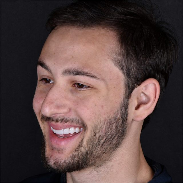 Odontologia estética, caso 6, registro do sorriso